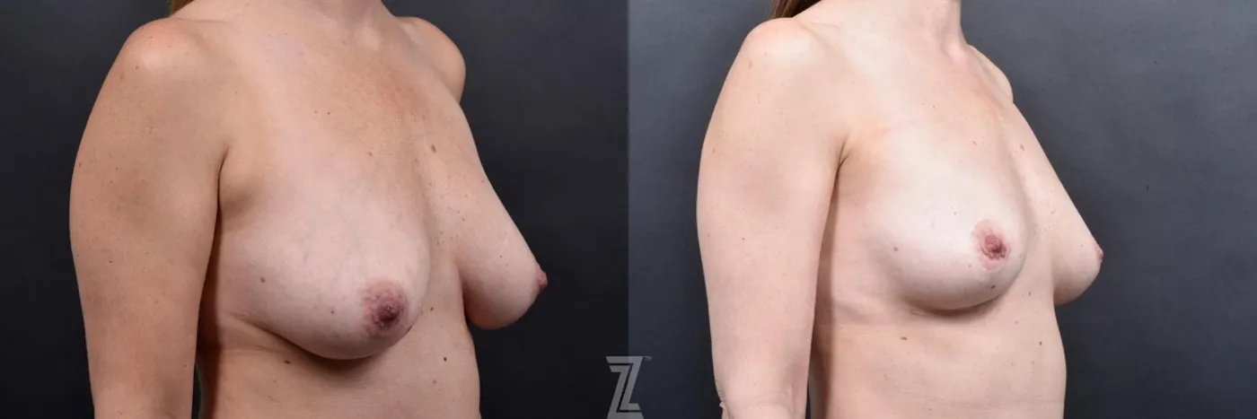 Austin Breast Reduction Before & After Gallery - Patient 606521 - Image 4 - The Piazza Center