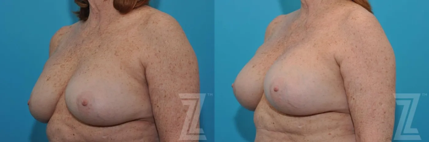 Austin Breast Augmentation Revision Before & After Gallery - Patient 132886549 - Image 2 - The Piazza Center