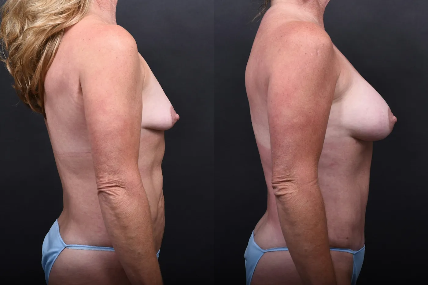 Austin Mommy Makeover Before & After Gallery - Patient 132903363 - Image 3 - The Piazza Center