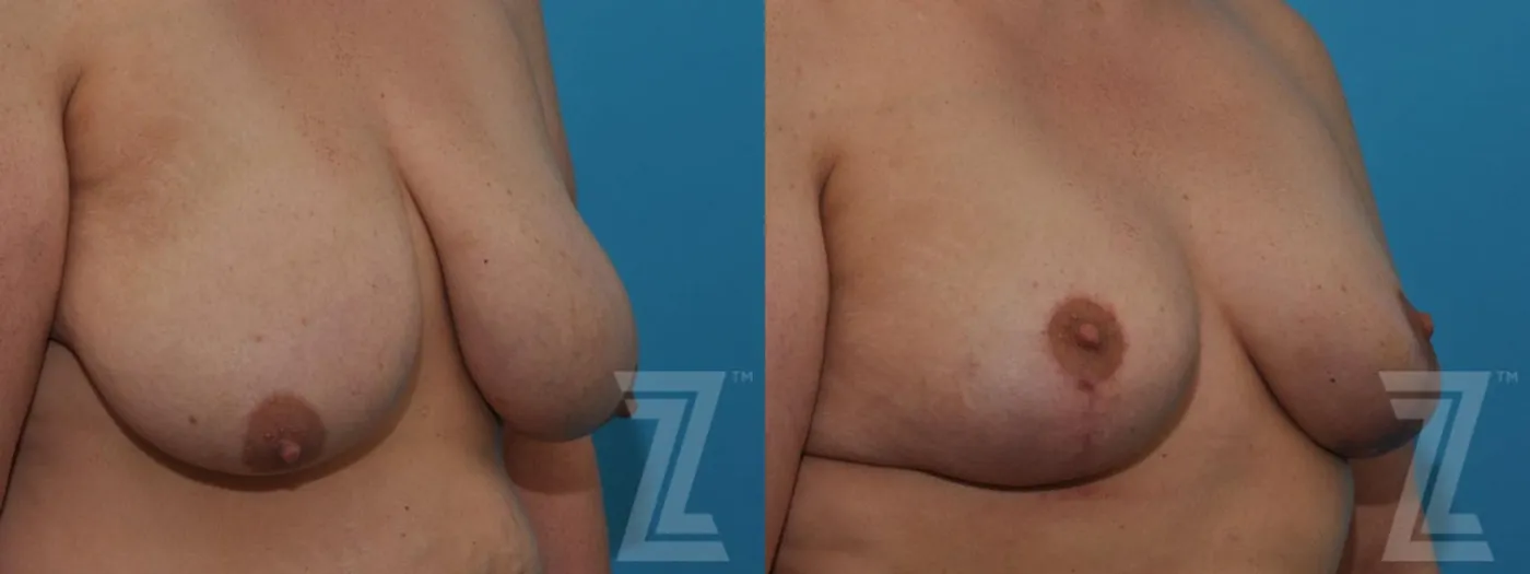Austin Breast Reduction Before & After Gallery - Patient 132886599 - Image 4 - The Piazza Center