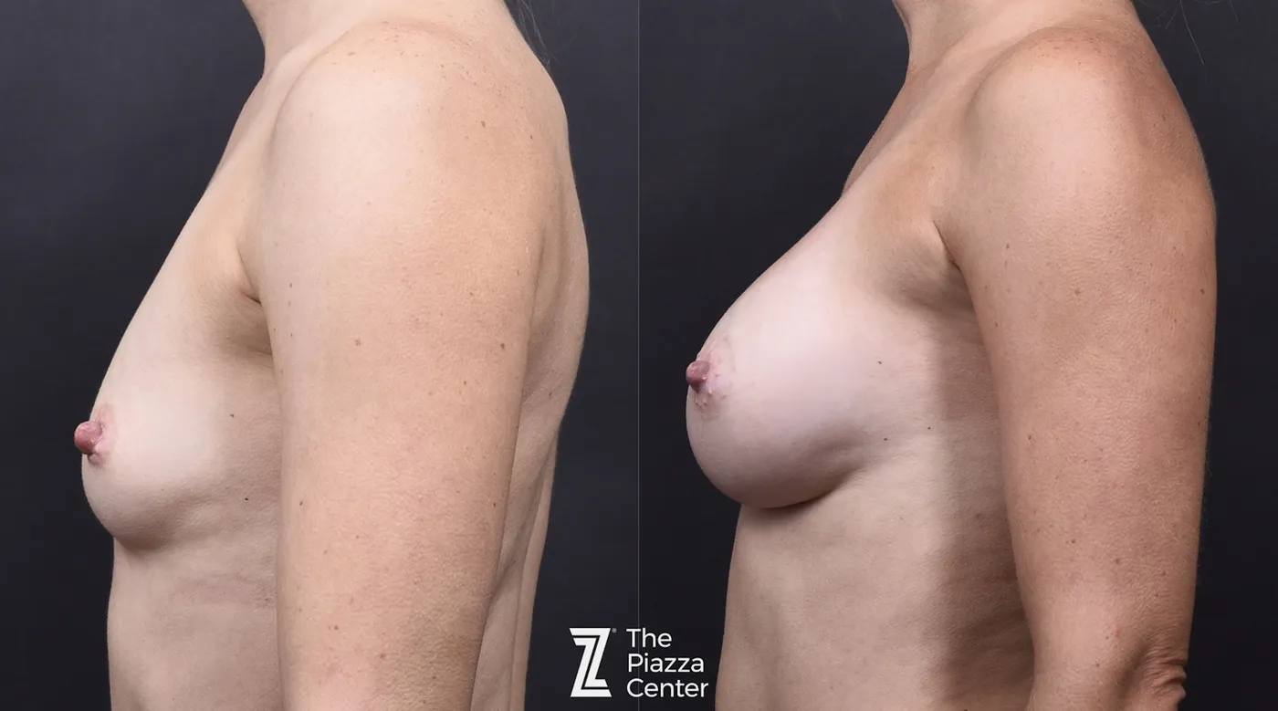 Austin Motiva Implants Before & After Gallery - Patient 657011 - Image 5 - The Piazza Center