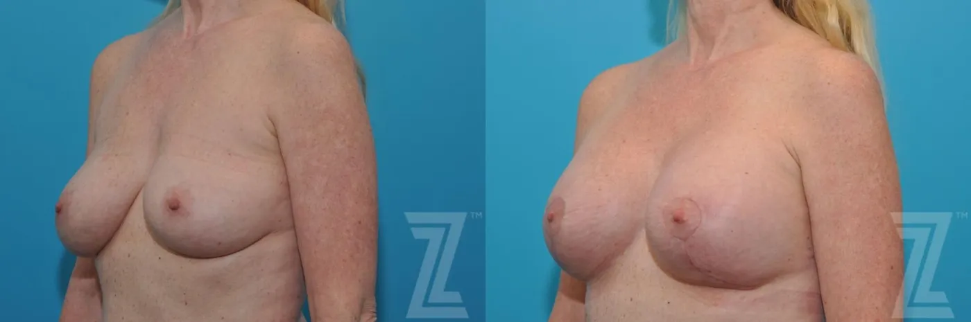 Austin Breast Augmentation Revision Before & After Gallery - Patient 132794909 - Image 2 - The Piazza Center