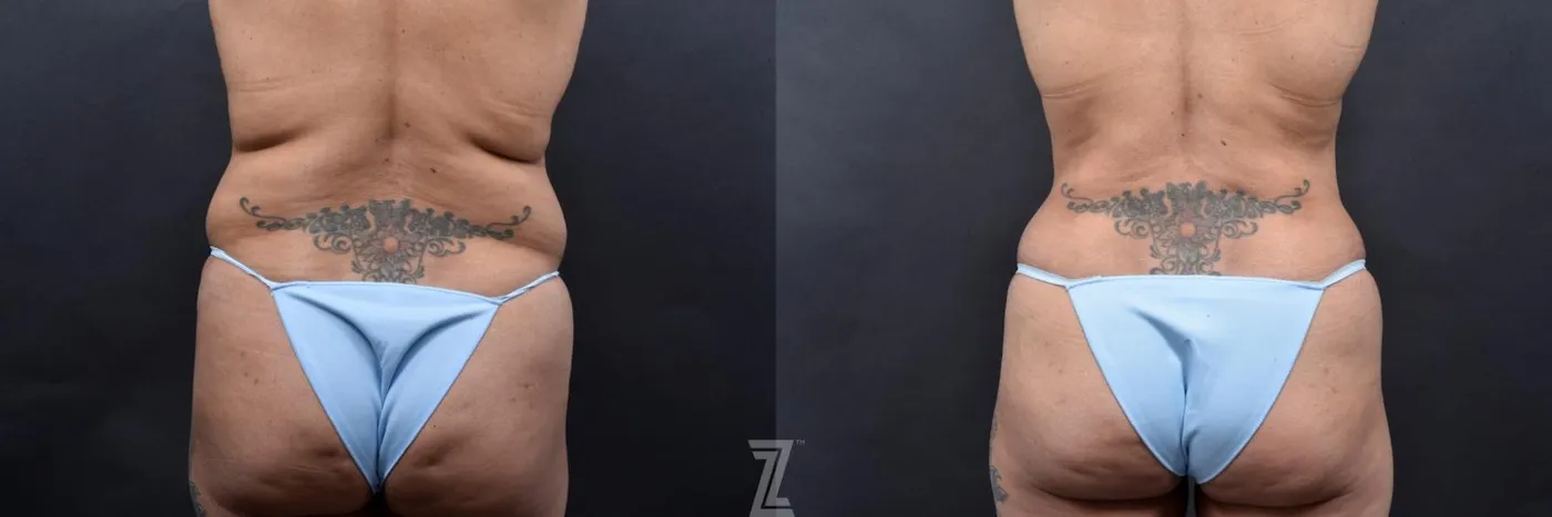 Austin 52-Year-Old Mommy Makeover Before & After by Dr. Rocco Piazza in Austin, Texas - Posterior View - The Piazza Center