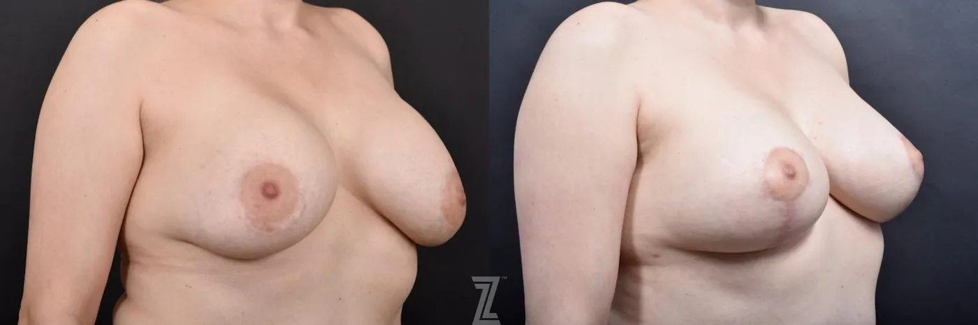 Austin Breast Augmentation Revision Before & After Gallery - Patient 132886548 - Image 4 - The Piazza Center