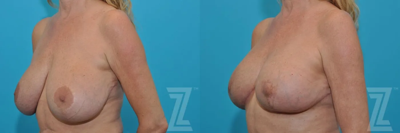 Austin Breast Augmentation Revision Before & After Gallery - Patient 132886579 - Image 2 - The Piazza Center