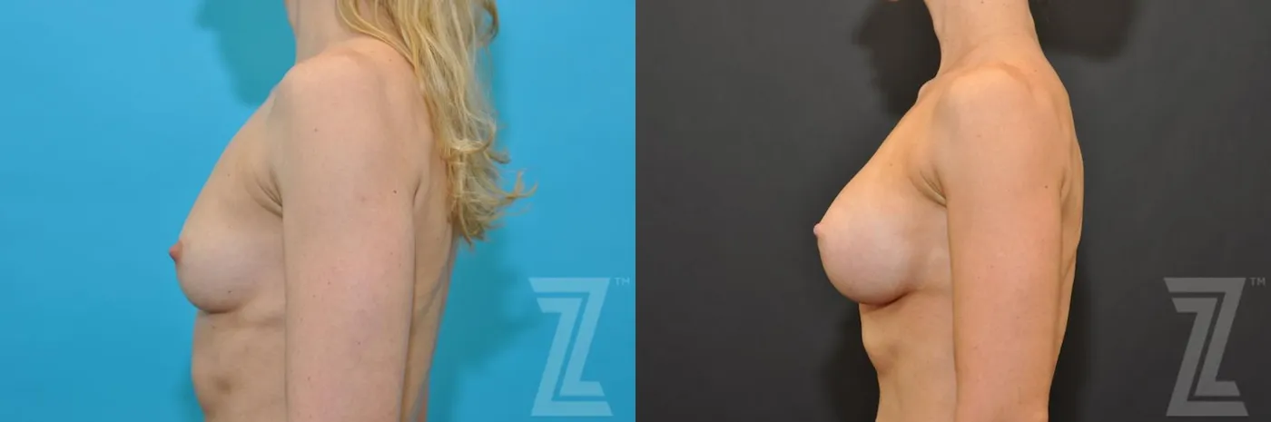 Austin Lateral View before and after of 36 year old woman with Silicone Implants with Highly Cohesive Gel (Gummy Bear Implants) - The Piazza Center - The Piazza Center