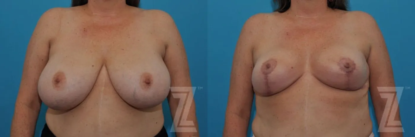 Austin Breast Reduction Before & After Gallery - Patient 132886747 - Image 2 - The Piazza Center