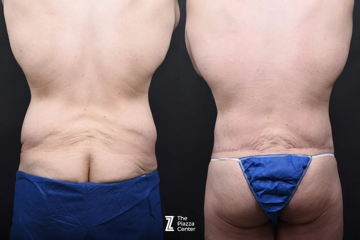 Austin Liposuction Before & After Gallery - Patient 313599 - Image 6 - The Piazza Center