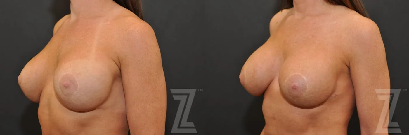 Austin Breast Augmentation Revision Before & After Gallery - Patient 132886594 - Image 2 - The Piazza Center