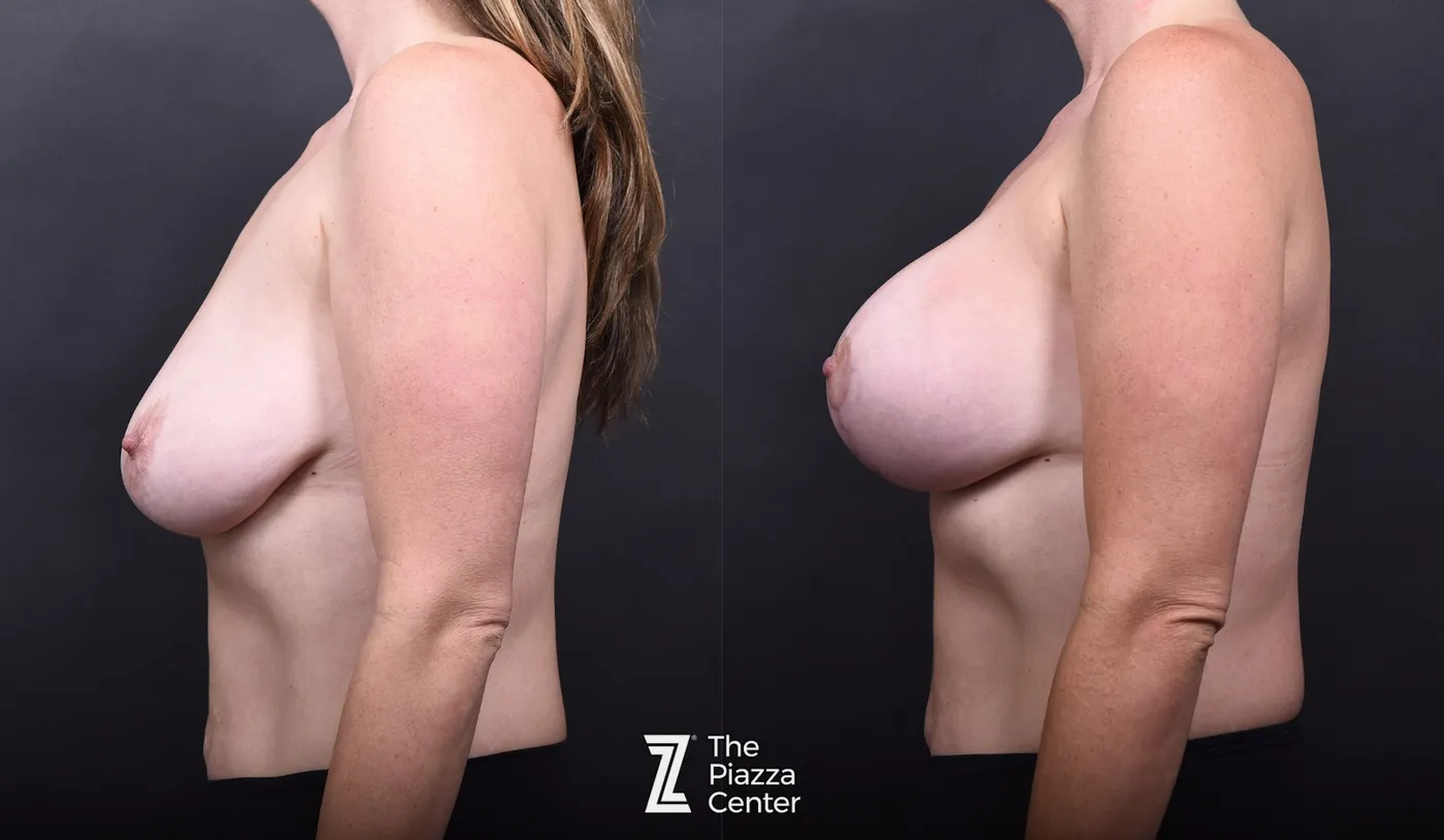 Austin Motiva Implants Before & After Gallery - Patient 225274 - Image 5 - The Piazza Center