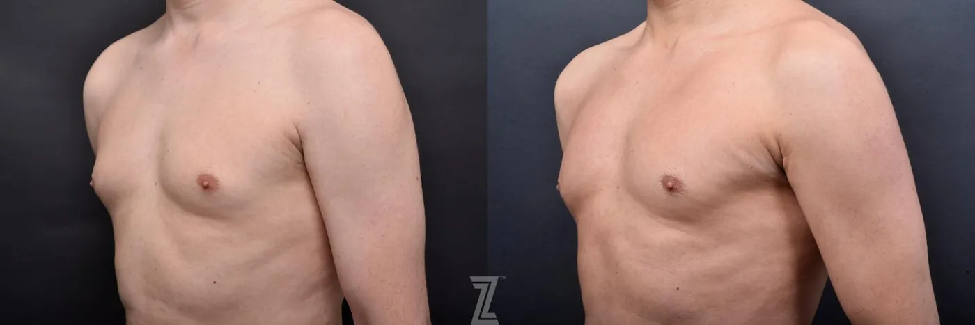 Austin Liposuction Before & After Gallery - Patient 132886947 - Image 5 - The Piazza Center