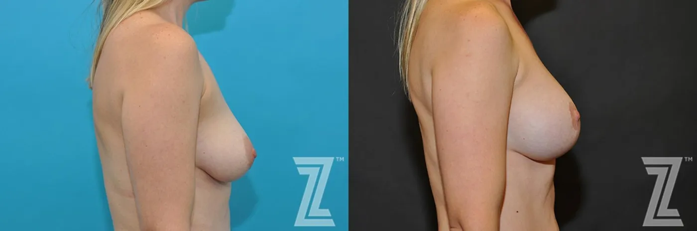 Austin Breast Augmentation With a Breast Lift Before & After Gallery - Patient 132791083 - Image 4 - The Piazza Center