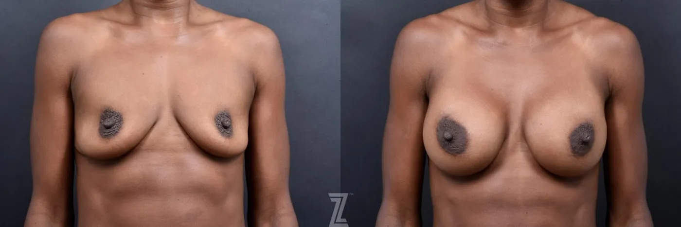 Austin Bilateral before and after view of 33 year old athletic mom of two children breast augmentation - The Piazza Center