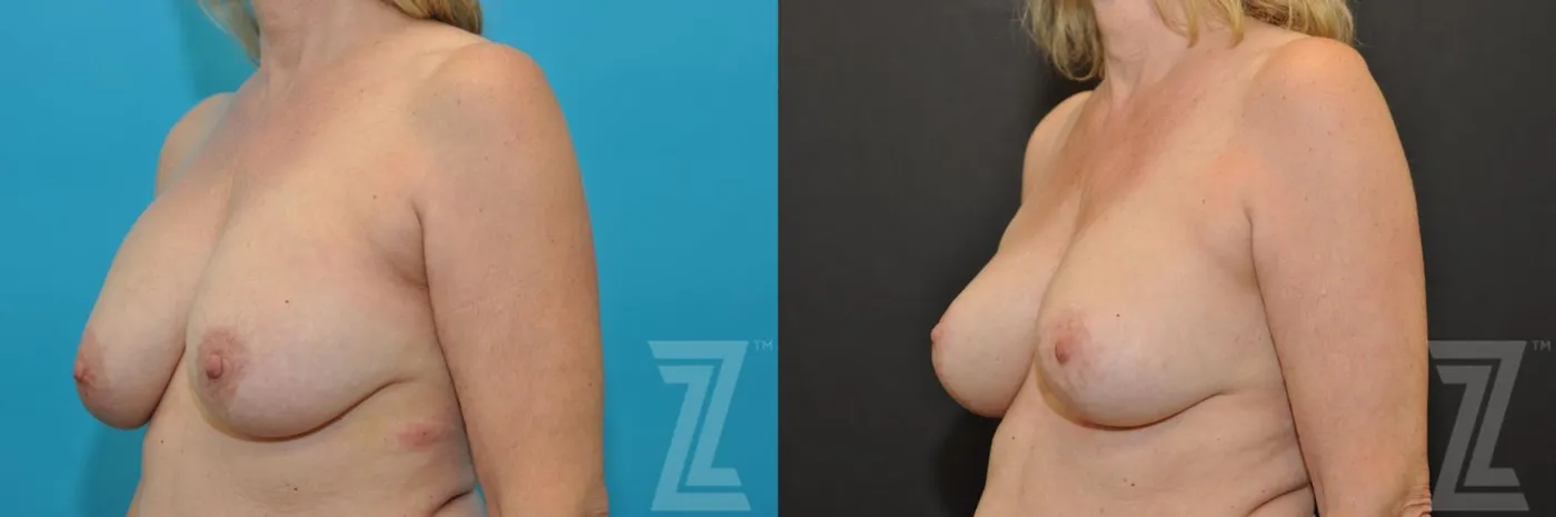 Austin Breast Augmentation Revision Before & After Gallery - Patient 132793346 - Image 2 - The Piazza Center