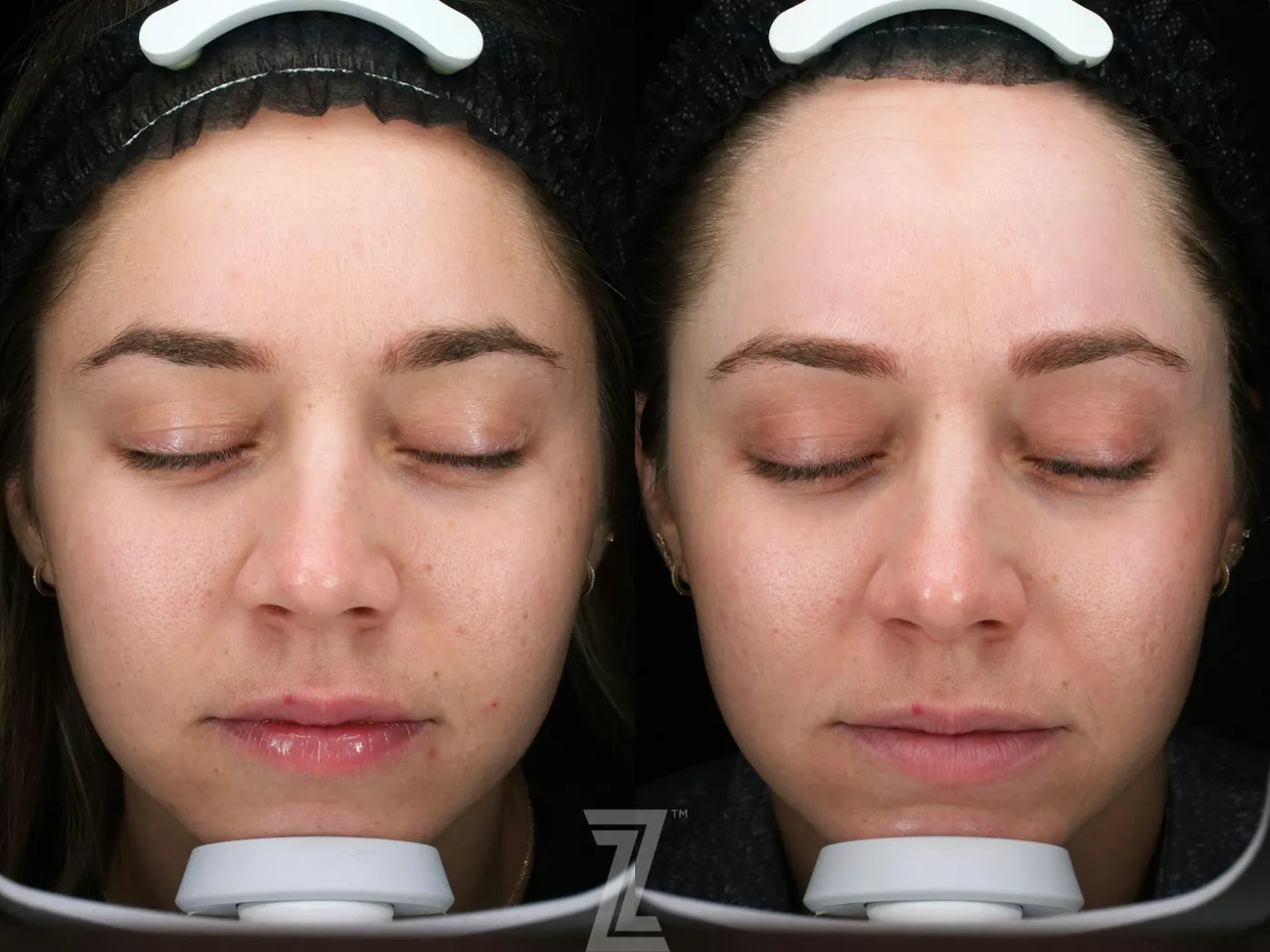 Austin SkinPen Microneedling Before & After Gallery - Patient 270635 - Image 2 - The Piazza Center