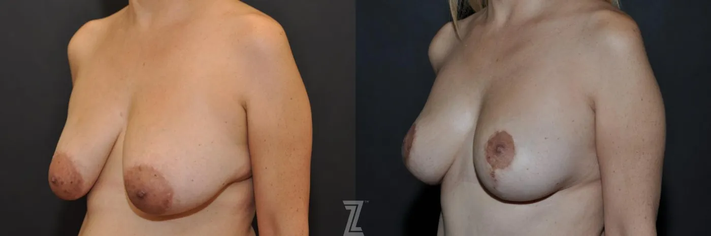 Austin Breast Reduction Before & After Gallery - Patient 132886614 - Image 2 - The Piazza Center