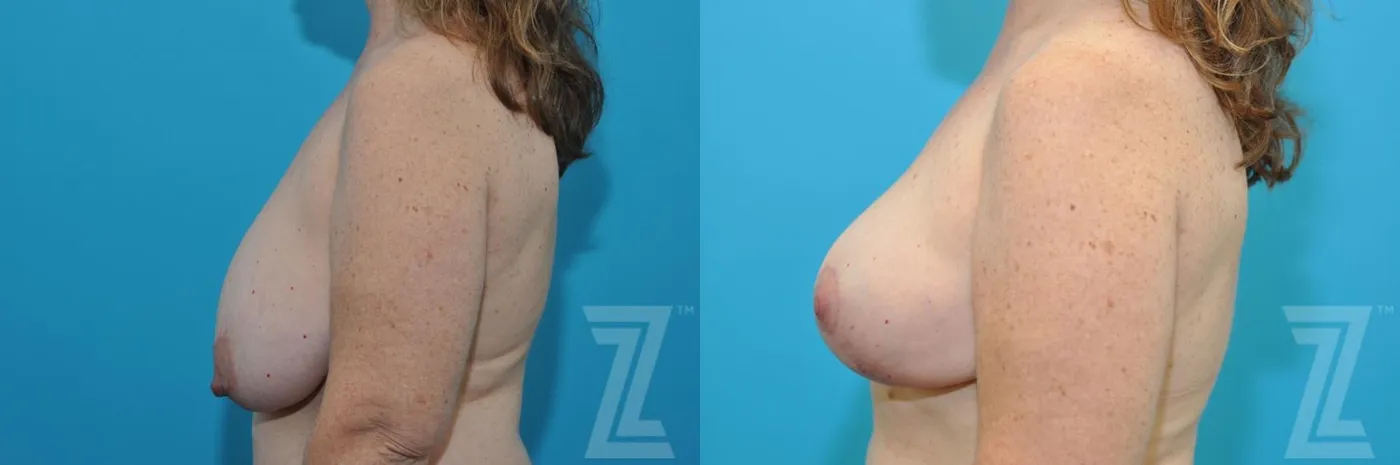Austin Breast Reduction Before & After Gallery - Patient 132886744 - Image 3 - The Piazza Center