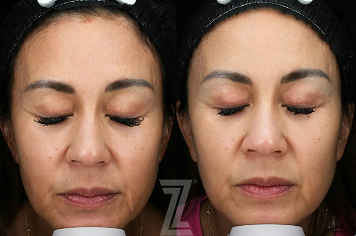 Austin SkinPen Microneedling Before & After Gallery - Patient 324647 - Image 1 - The Piazza Center