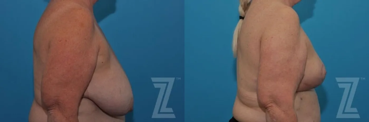 Austin Breast Reduction Before & After Gallery - Patient 132886611 - Image 5 - The Piazza Center