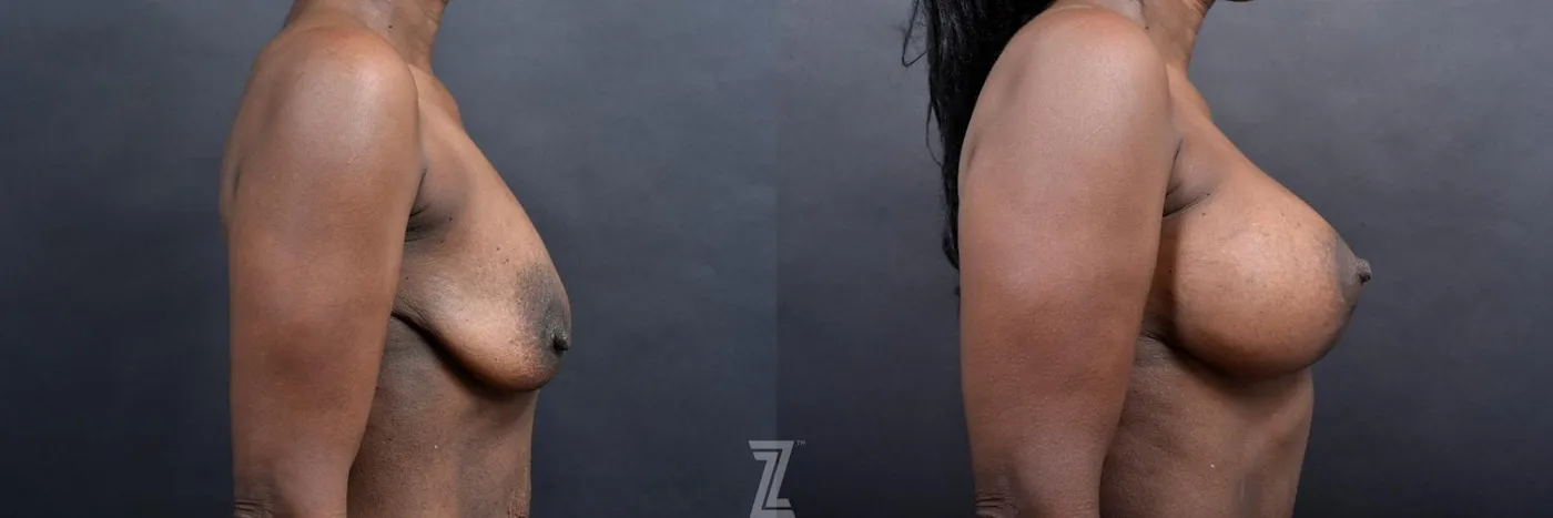 Austin 1 Year Post-OP Mommy Makeover in Austin, TX by Dr. Rocco Piazza - Lateral View of Breasts - The Piazza Center