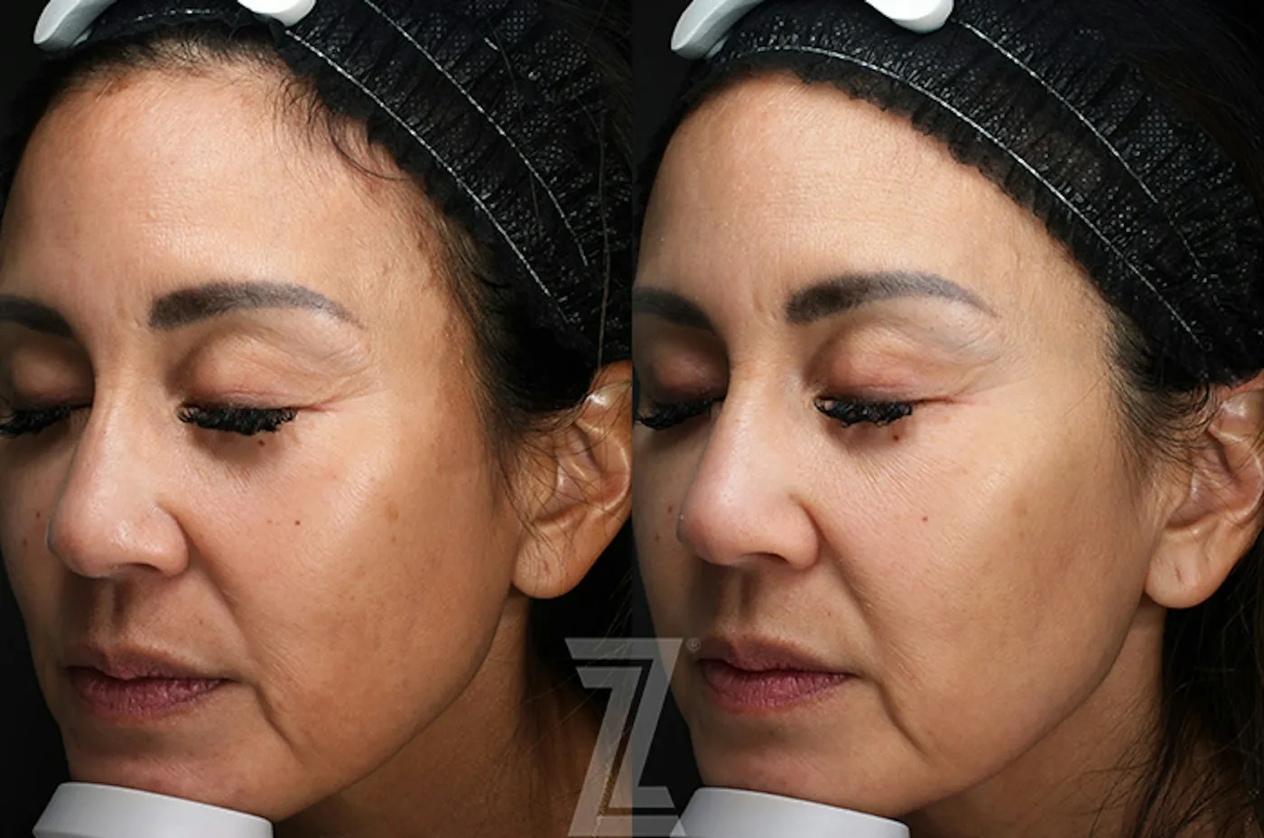 Austin SkinPen Microneedling Before & After Gallery - Patient 324647 - Image 3 - The Piazza Center