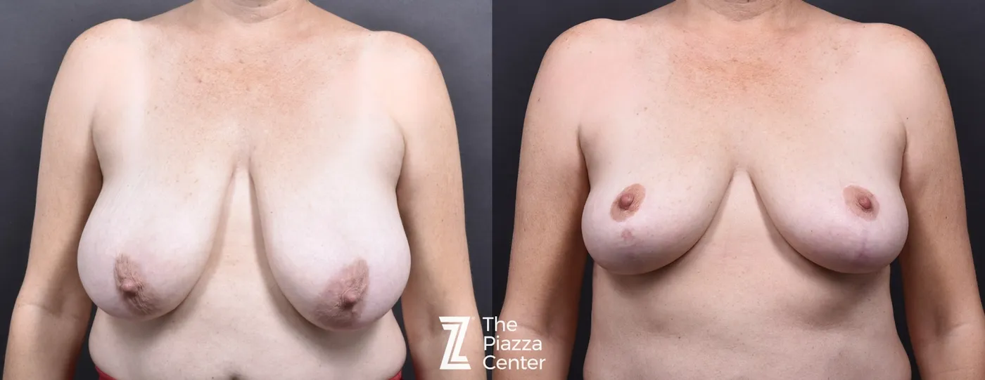 Austin Breast Lift Before & After Gallery - Patient 342651 - Image 1 - The Piazza Center