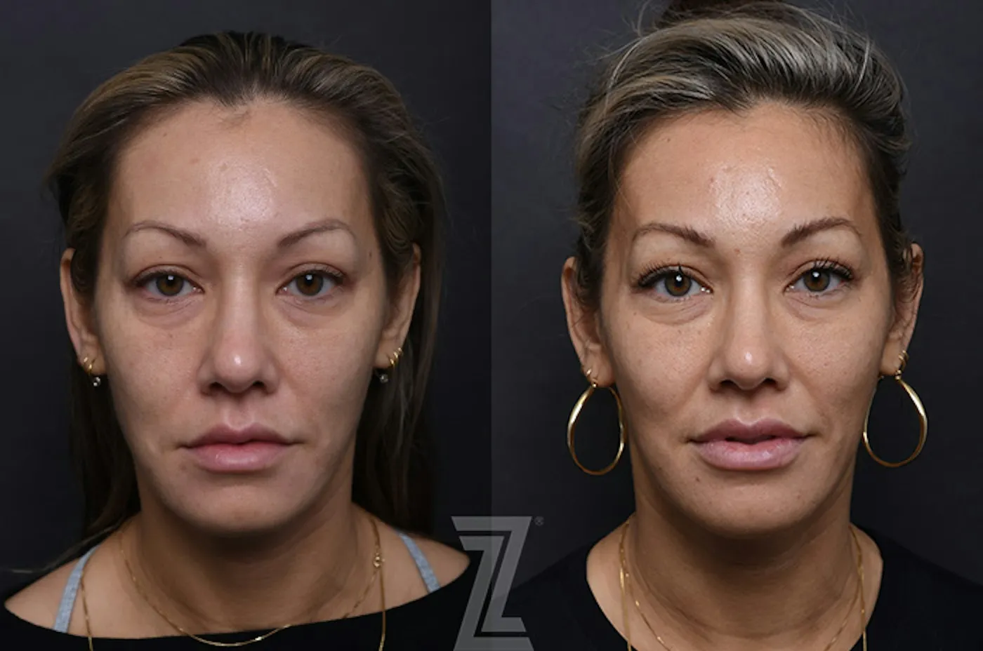 Austin Injectable Fillers Before & After Gallery - Patient 407560 - Image 1 - The Piazza Center