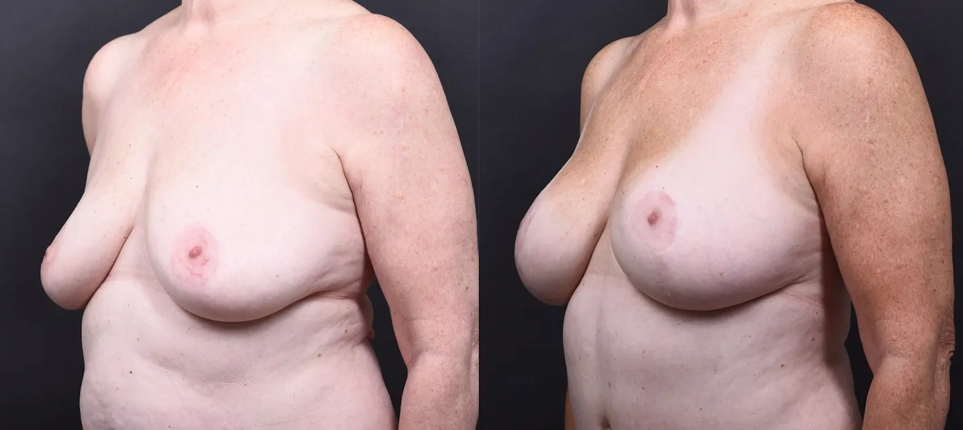 Austin Mommy Makeover Before & After Gallery - Patient 820235 - Image 7 - The Piazza Center