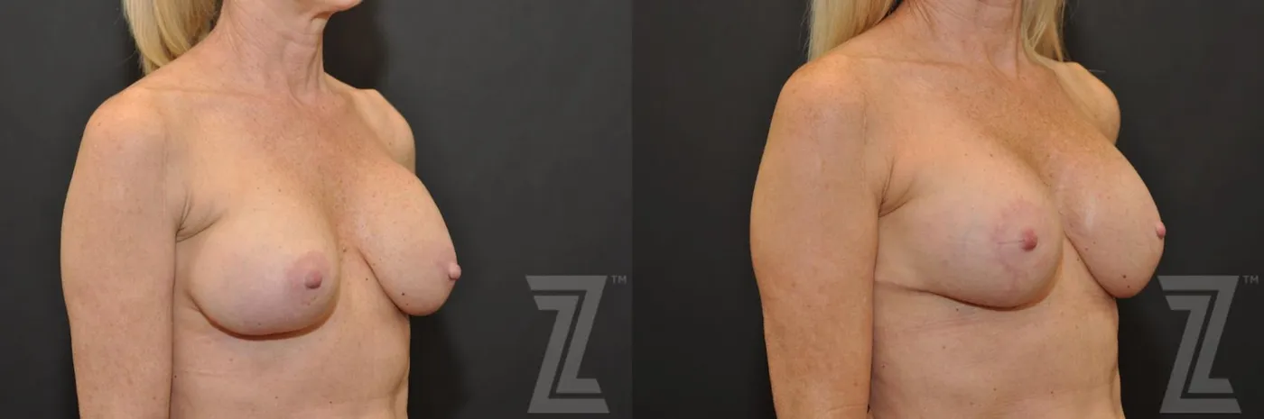 Austin Breast Augmentation Revision Before & After Gallery - Patient 132886535 - Image 4 - The Piazza Center
