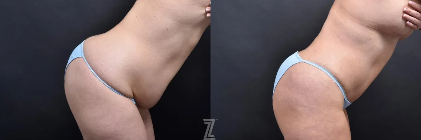 Austin Flexion Oblique View from Mommy Makeover of 41 year old woman in Austin, TX by Dr. Rocco Piazza - Before & After - The Piazza Center