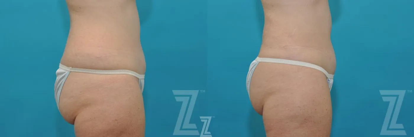 Austin Liposuction Before & After Gallery - Patient 132887304 - Image 4 - The Piazza Center