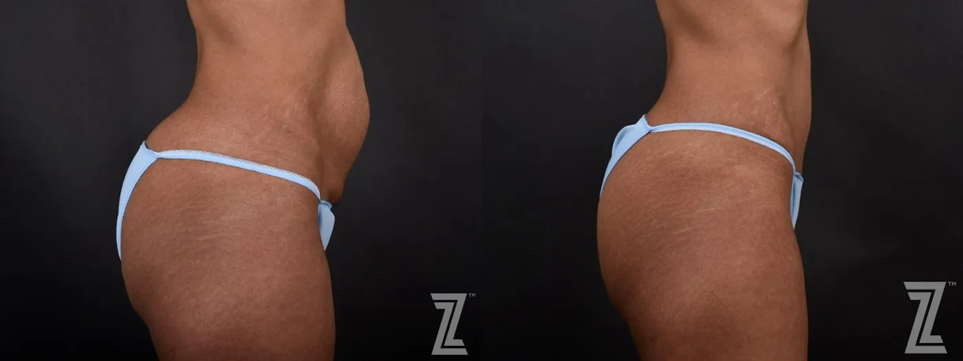 Austin Lateral View of Abdomen of 34-Year-Old Mom with Three Children Mommy Makeover Before & After by Dr. Rocco Piazza in Austin, Texas - The Piazza Center