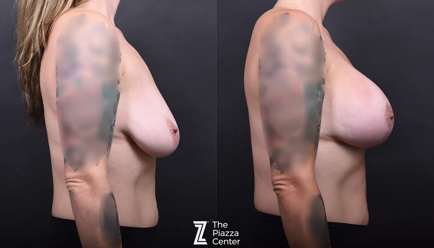 Austin Motiva Implants Before & After Gallery - Patient 225274 - Image 3 - The Piazza Center