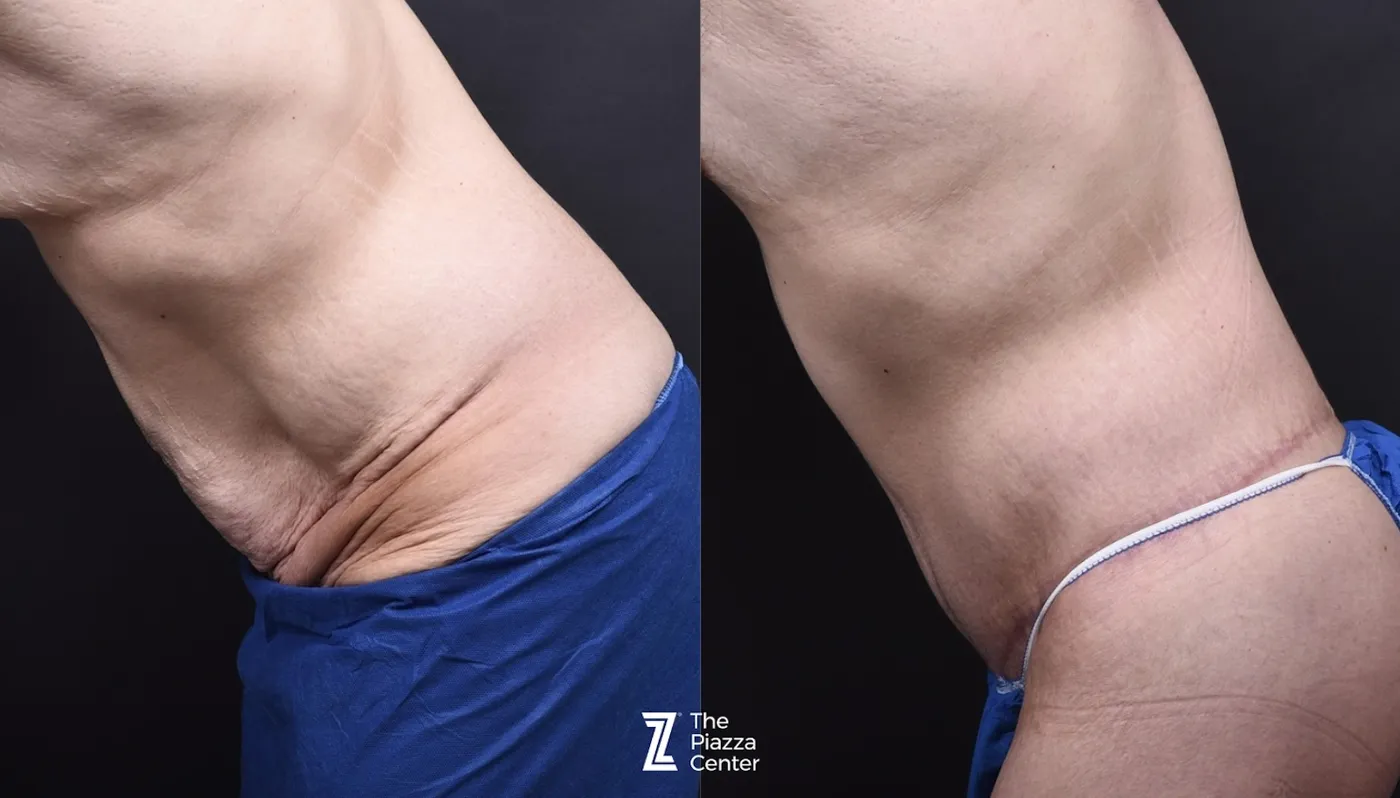 Austin Liposuction Before & After Gallery - Patient 313599 - Image 5 - The Piazza Center