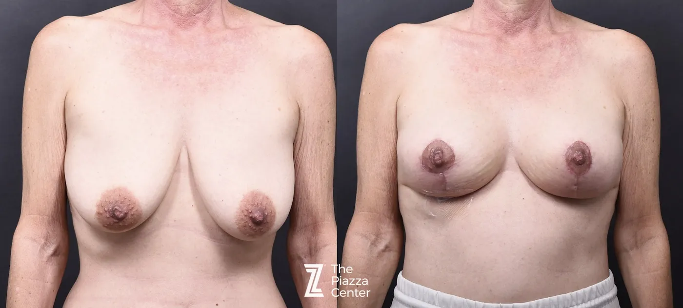 Austin Breast Augmentation With a Breast Lift - The Piazza Center
