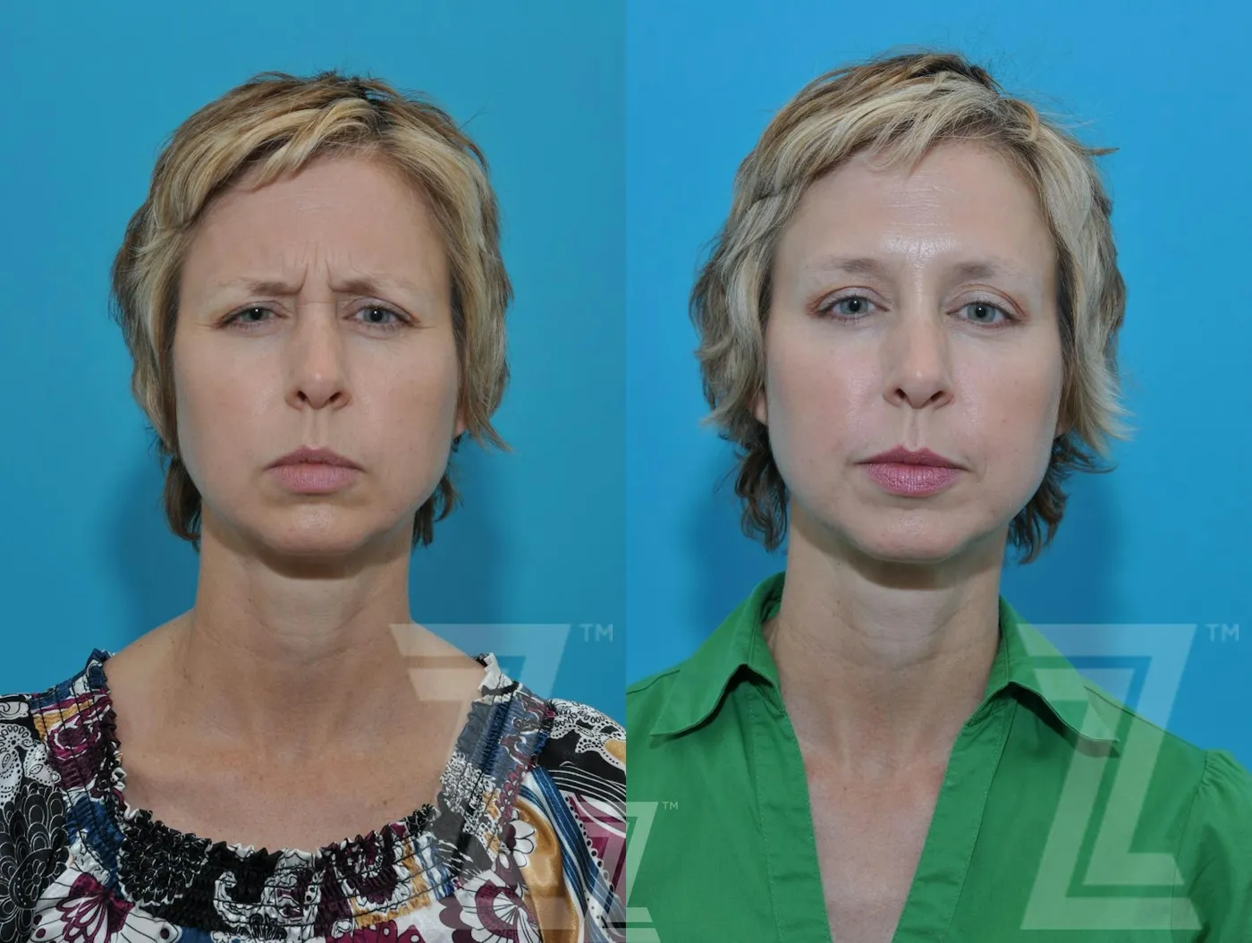 Austin Wrinkle Relaxers Before & After Gallery - Patient 132906319 - Image 2 - The Piazza Center