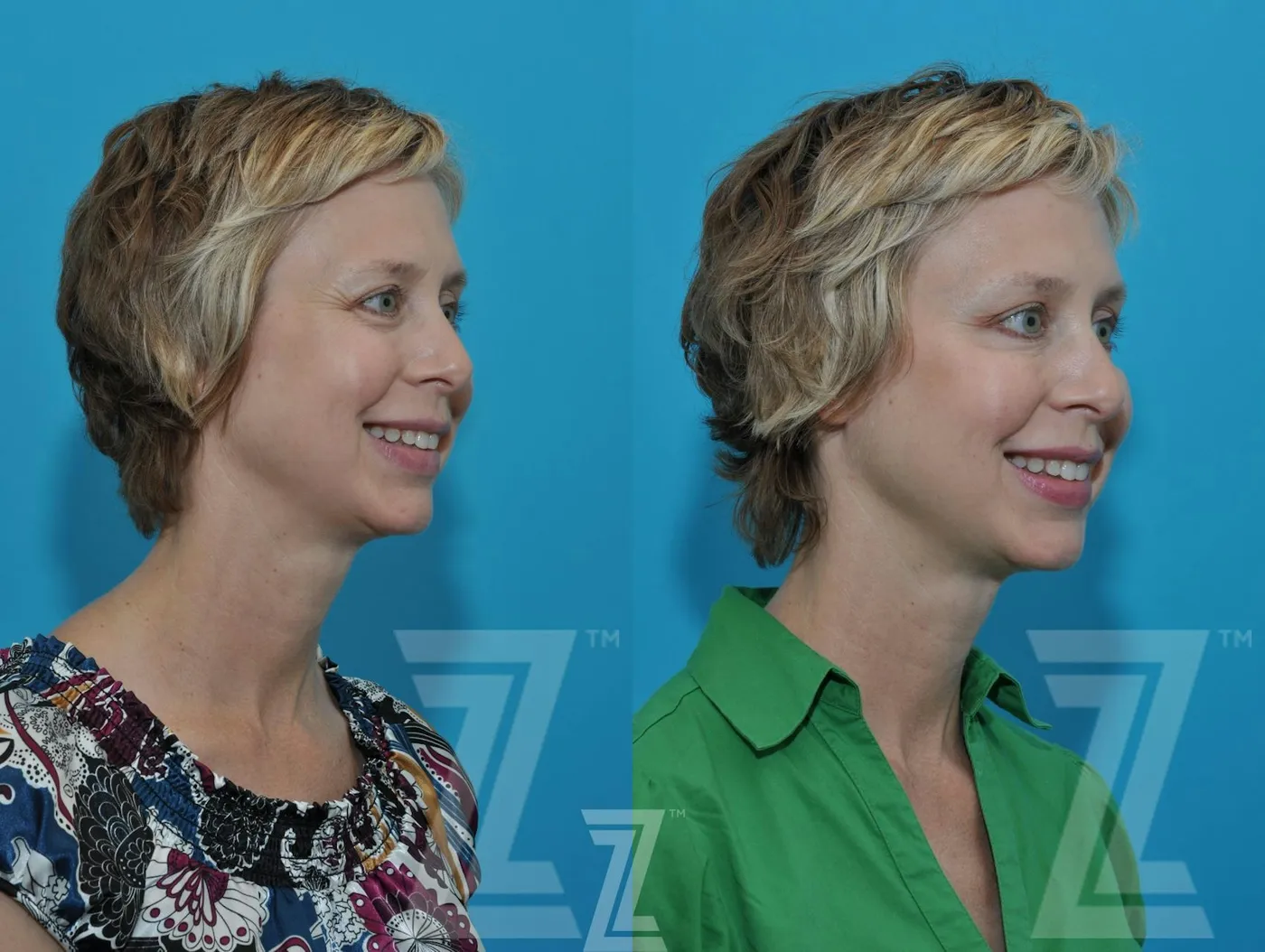 Austin Wrinkle Relaxers Before & After Gallery - Patient 132906319 - Image 5 - The Piazza Center