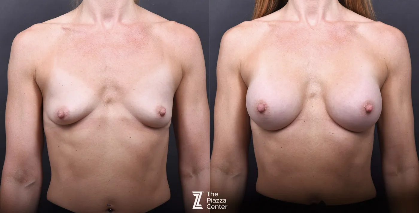 Austin Motiva Implants Before & After Gallery - Patient 245459 - Image 1 - The Piazza Center