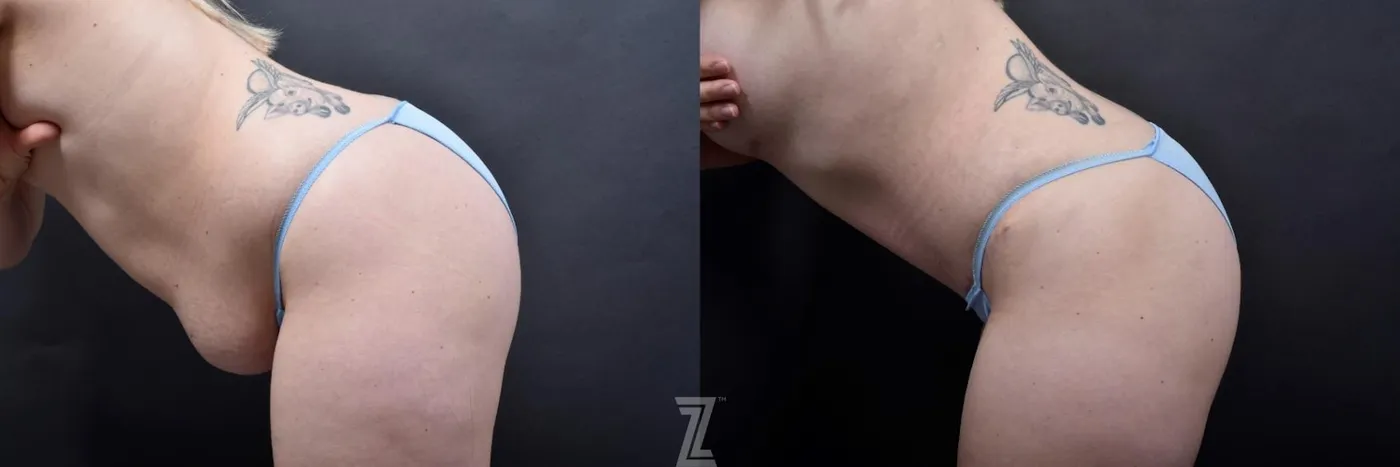 Austin 29-Year-Old Mommy Makeover Before & After by Dr. Rocco Piazza in Austin, Texas - Lateral View of Abdomen in Flexion - The Piazza Center