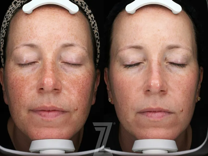 Austin Moxi Before & After Gallery - Patient 355580 - Image 1 - The Piazza Center