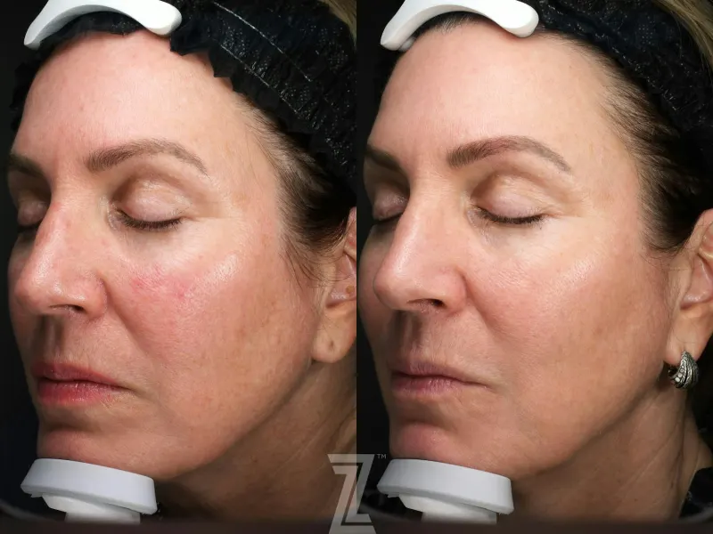 Austin Moxi Before & After Gallery - Patient 362380 - Image 1 - The Piazza Center