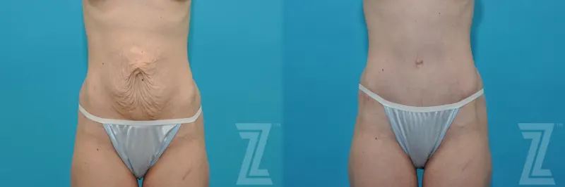 Austin Tummy Tuck Before & After Gallery - Patient 132886867 - Image 1 - The Piazza Center