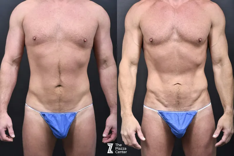 Austin Liposuction Before & After Gallery - Patient 355670 - Image 1 - The Piazza Center