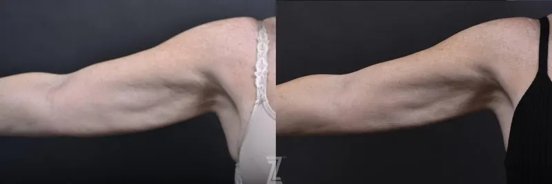 Austin Profound® RF Microneedling Before & After Gallery - Patient 132963569 - Image 1 - The Piazza Center