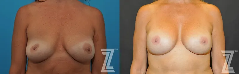 Austin Breast Augmentation Revision Before & After Gallery - Patient 132886563 - Image 1 - The Piazza Center
