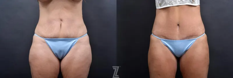 Austin Tummy Tuck Before & After Gallery - Patient 132886877 - Image 1 - The Piazza Center