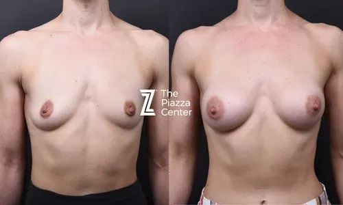 Front view before and after post-pregnancy breast augmentation with 205cc Motiva Ergonomix Demi implants, Austin TX