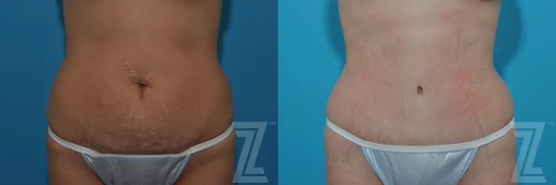 Austin Tummy Tuck Before & After Gallery - Patient 132886879 - Image 1 - The Piazza Center