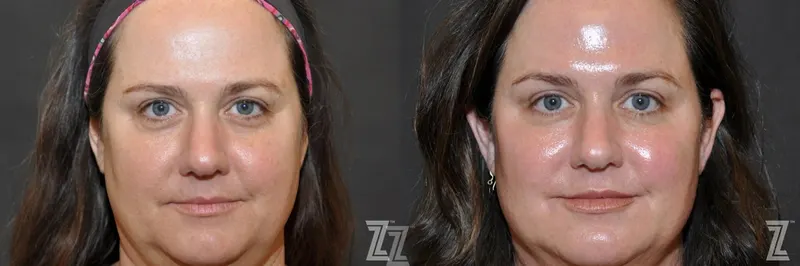 Austin Injectable Fillers Before & After Gallery - Patient 132906324 - Image 1 - The Piazza Center