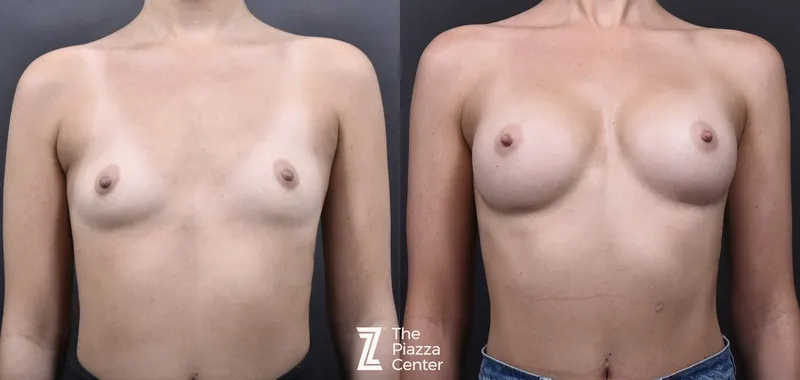 Austin Breast Augmentation Before & After Gallery - Patient 790705 - Image 1 - The Piazza Center
